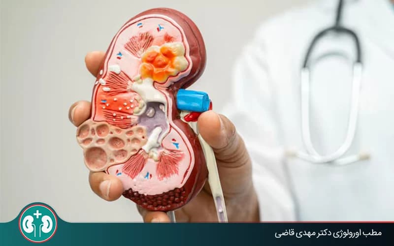 ما سرطان الكلى؟ وهل سرطان الكلى مميت؟