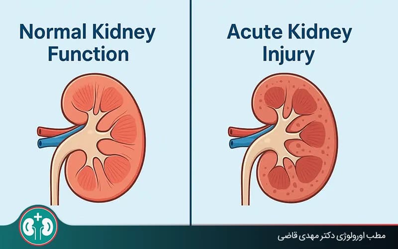 ما هو الفشل الكلوي الحاد؟ الأعراض ومراحل العلاج والنظام الغذائي