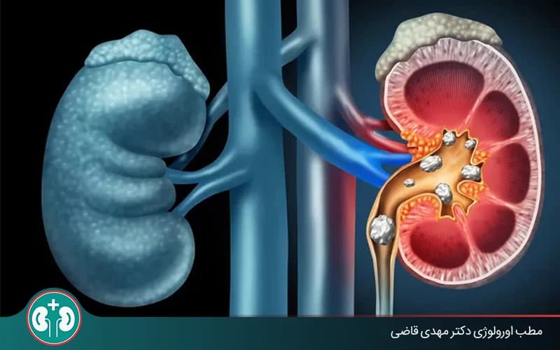 كيف تخرج حصوة الكلى من الحالب؟