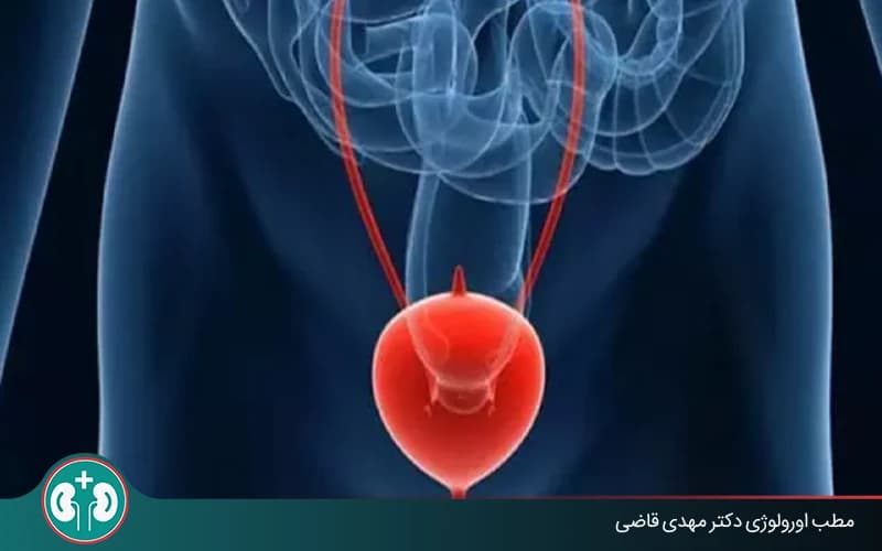 What Is a Bladder Cyst? Symptoms, Causes, Diagnosis, and Treatment