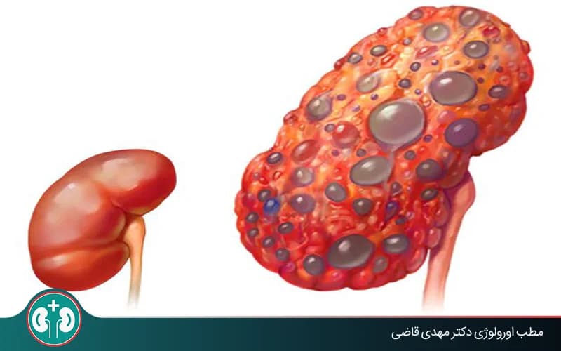 What Is Polycystic Kidney Disease? (Fetal and Adult PKD)