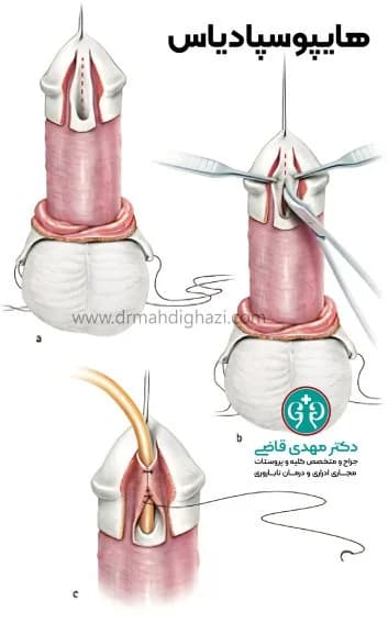 الدكتور مهدي قاضي -هیپوسپادیاس