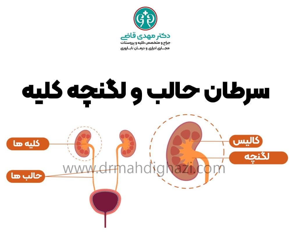 الدكتور مهدي قاضي-سرطان حالب و لگنچه کلیه: علائم، تشخیص و درمان
