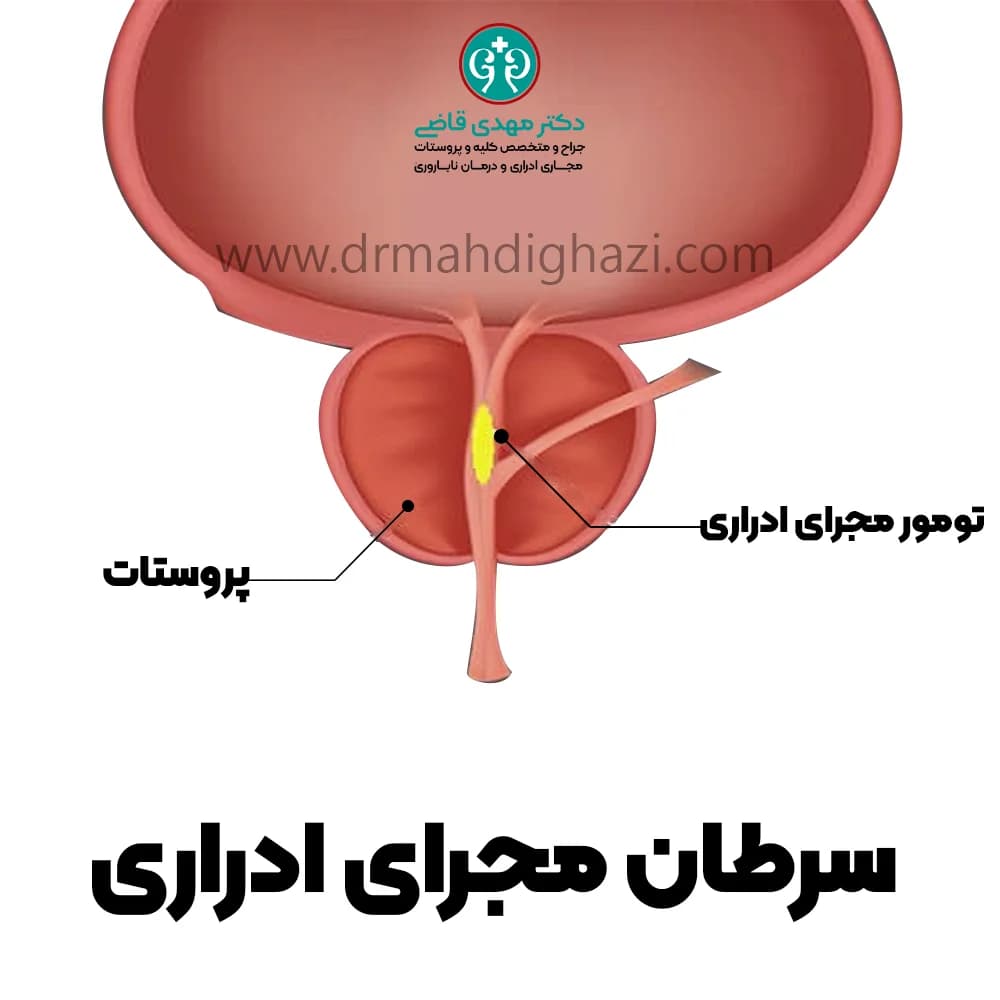 الدكتور مهدي قاضي- سرطان مجرای ادراری