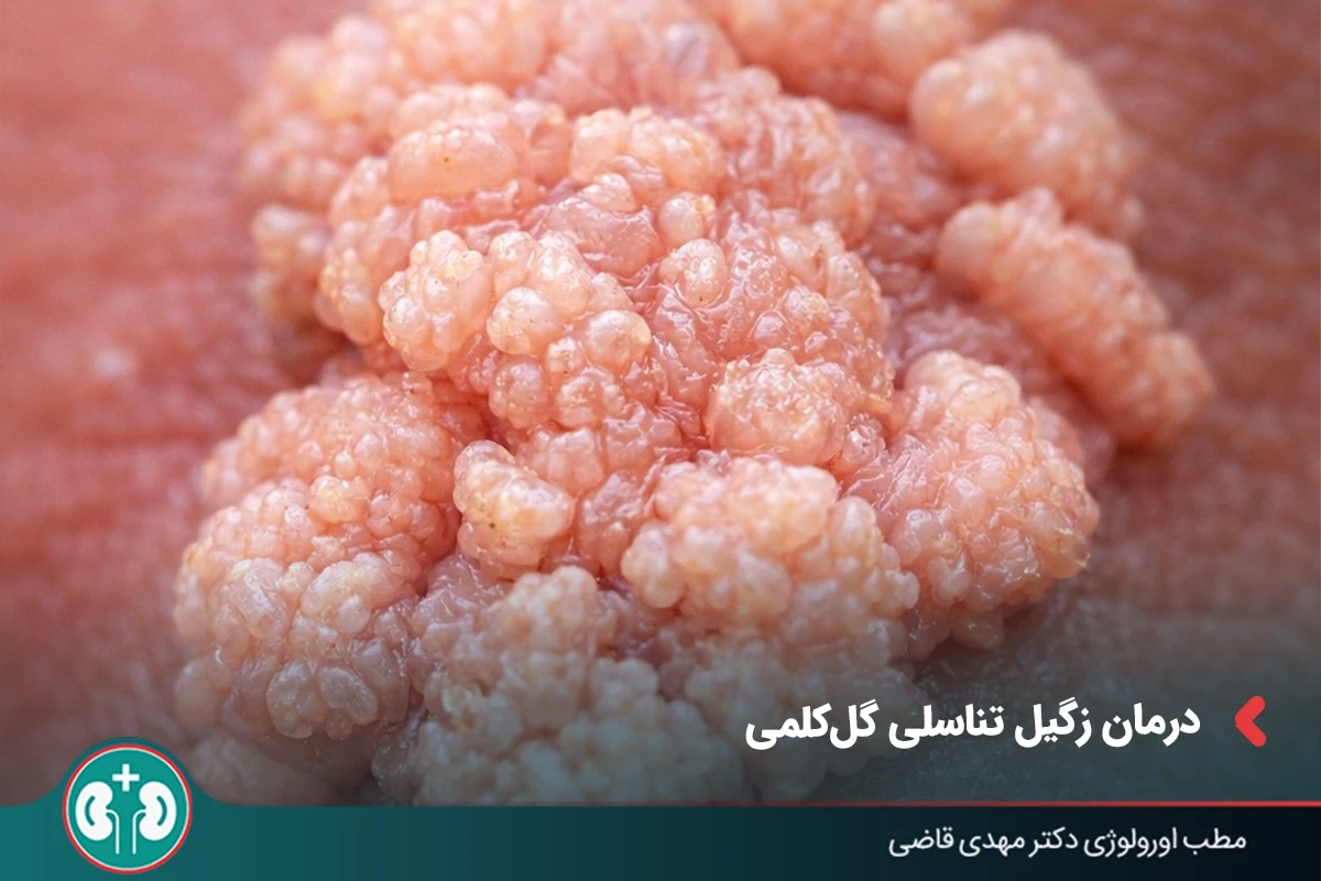 درمان زگیل تناسلی گل‌کلمی و خوشه‌ای | لیزر، فریز، جراحی
