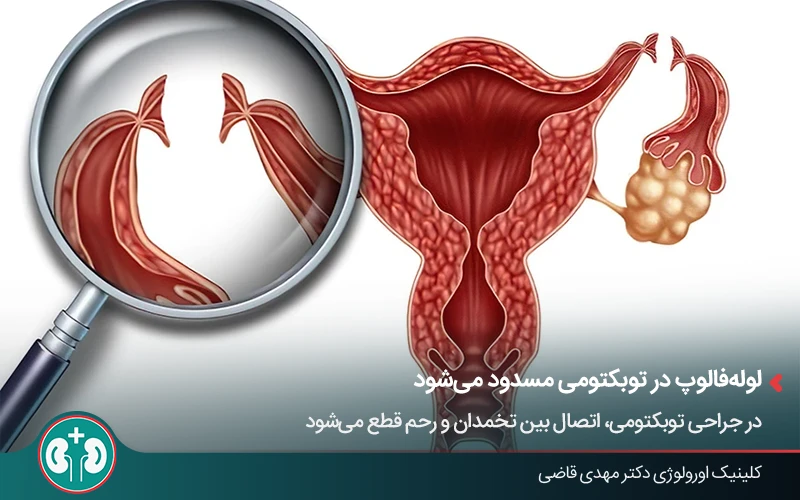 تصویر گرافیکی از روش‌های بستن لوله فالوپ در جراحی توبکتومی زنان