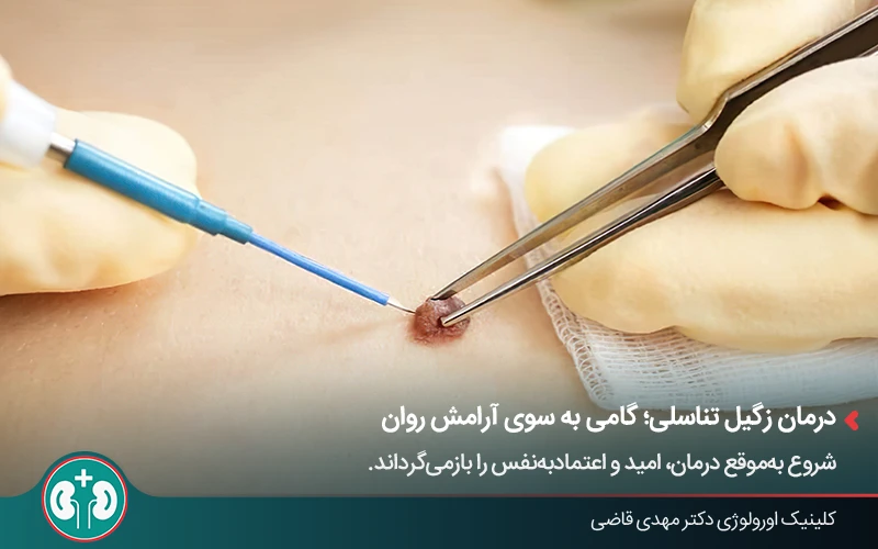 درمان زگیل تناسلی با استفاده از روش‌های فیزیکی و لیزر