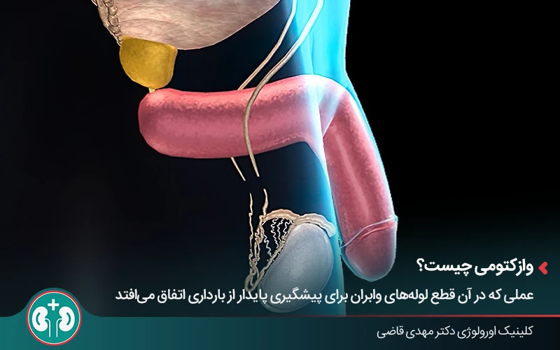 تصویر سه‌بعدی از فرآیند بستن لوله اسپرماتیک در جراحی وازکتومی