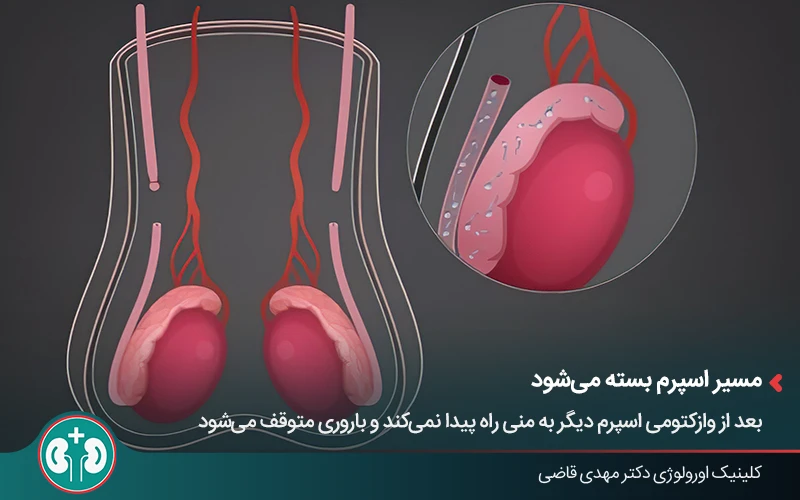 ۹۰ درصد مردان پس از وازکتومی با عارضه جدی مواجه نمی‌شوند؛ اما بررسی عوارض احتمالی ضروری است