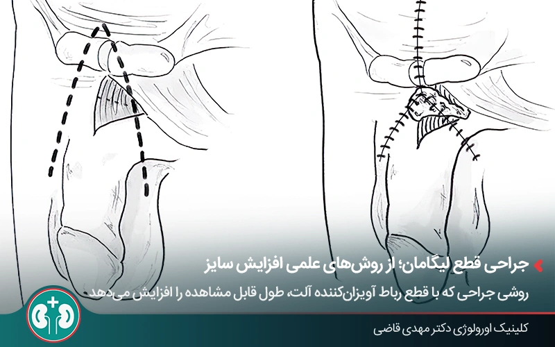نمای شماتیک جراحی قطع لیگامان آلت تناسلی برای افزایش طول آن