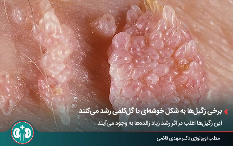 Image of cauliflower-like genital warts