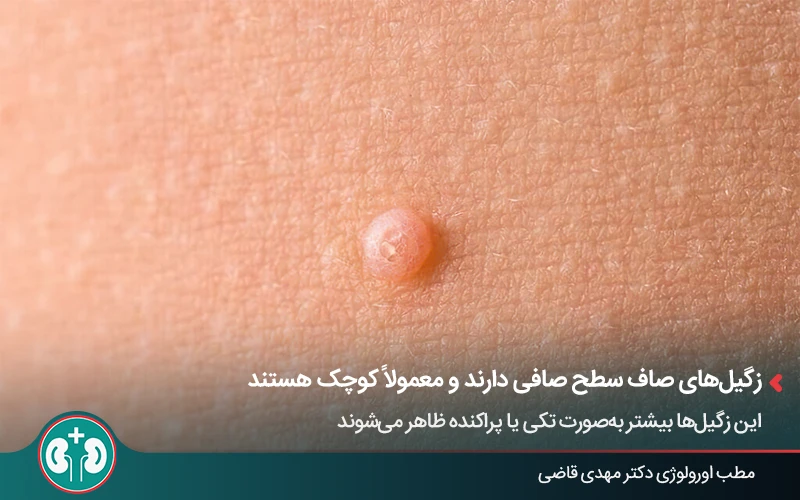 Image of flat genital warts