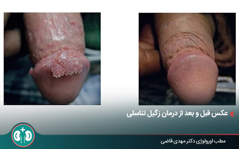Comparison image before and after treatment of genital warts in the male genital area