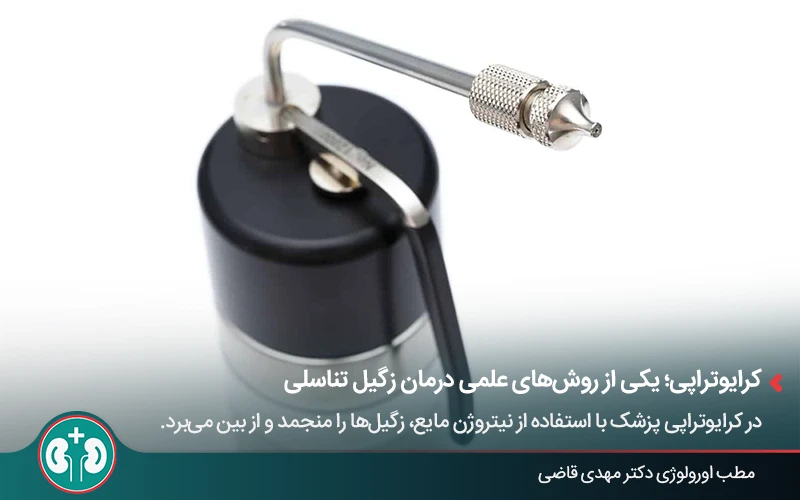 دستگاه کرایوتراپی، یکی از روش‌های درمان زگیل تناسلی