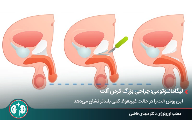 نحوه انجام جراحی قطع لیگامان از روش‌های افزایش طول آلت تناسلی