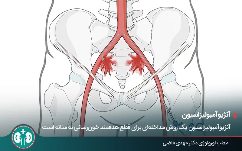 Graphic image of a catheter inside an artery - angioembolization