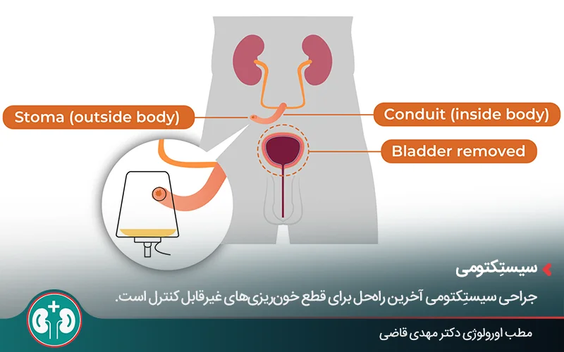Graphic image showing removal of the bladder and urine collecting in a bag
