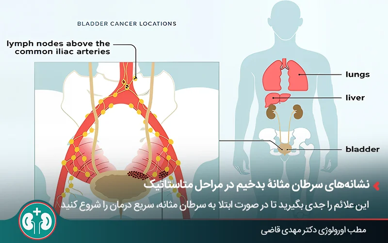نقشۀ بدن انسان با نمایش مثانه، غدد لنفاوی درگیر سرطان و همچنین اعضایی مانند ریه، کبد و استخوان که سرطان مثانه می‌تواند به آن‌ها متاستاز دهد.