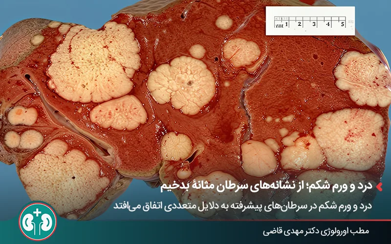 عکس واقعی یک کبد برش خورده با توده‌های سرطانی متعدد.