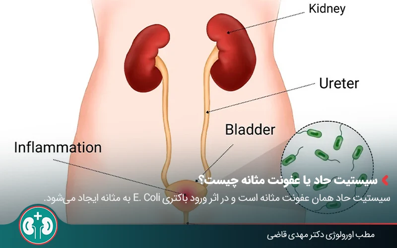 نمودار آناتومی دستگاه ادراری زنانه که محل عفونت را در عفونت مثانه (سیستیت) نشان میدهد