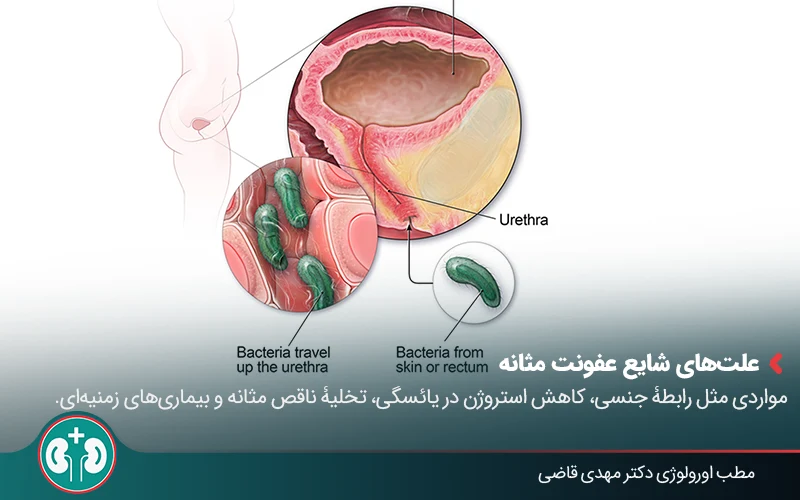 تصویر پزشکی که نشان میدهد چگونه باکتریها وارد مجرای ادرار میشوند.