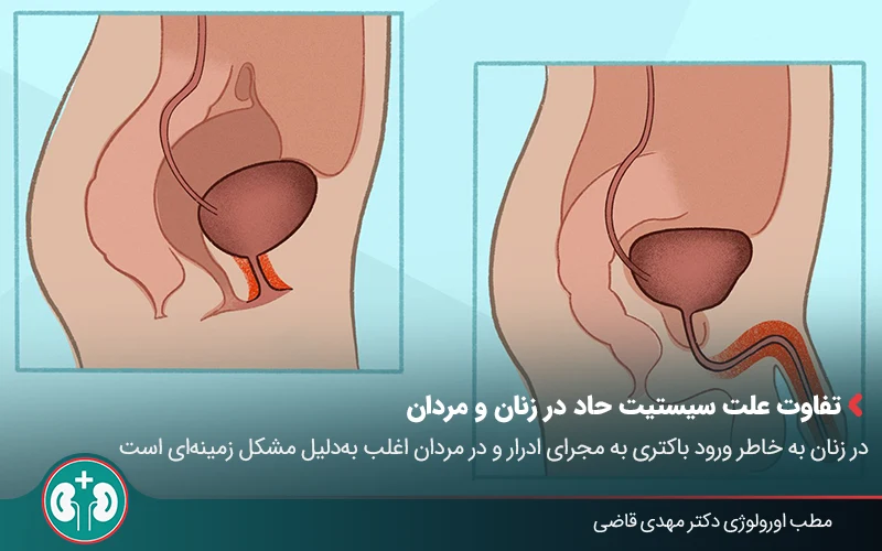 تصویری که با مقایسۀ طول مجرای ادرار زنان و مردان، نشان میدهد چرا در زنان ورود باکتریها به مثانه آسان است.