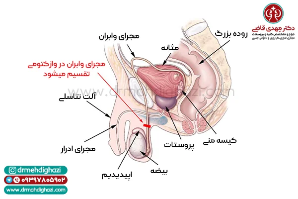 وازکتومی | هزینه عمل وازکتومی