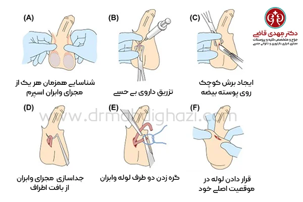 جراحی وازکتومی