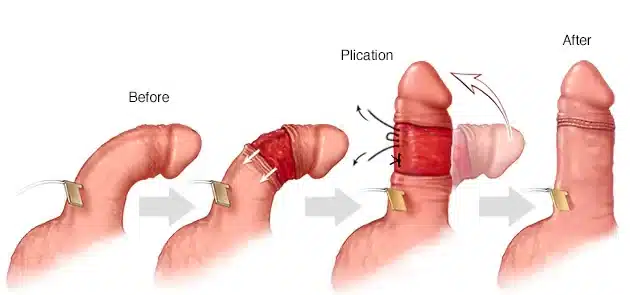 جراحی پلاک پیرونی
