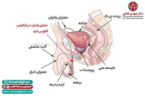 عمل وازکتومی در آقایان