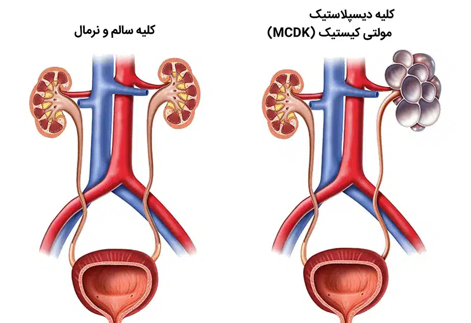 بیماری کیستیک کلیه در کودکان