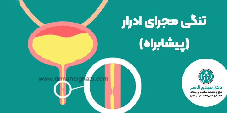 تنگی مجرای ادرار