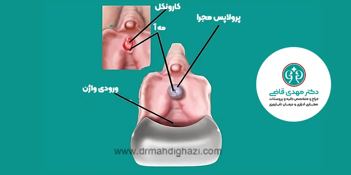 کارونکل مجرای ادرار