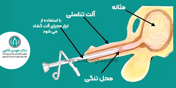 دیلاتاسیون