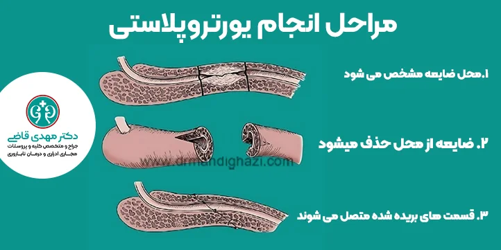 یورتروپلاستی