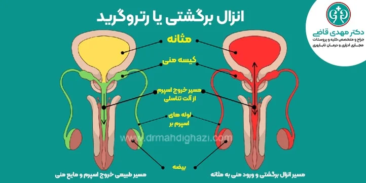 انزال برگشتی دکتر قاضی