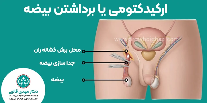 عمل جراحی برداشتن بیضه دکتر قاضی