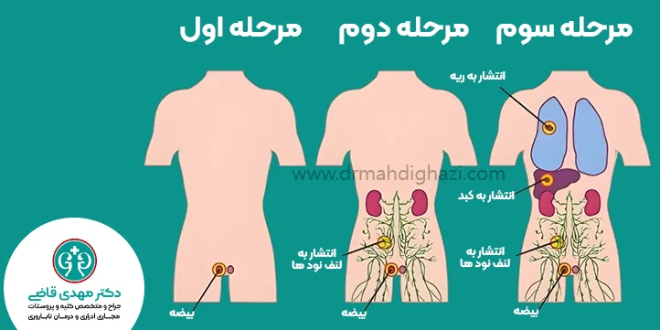 مراحل انتشار سرطان بیضه دکتر قاضی