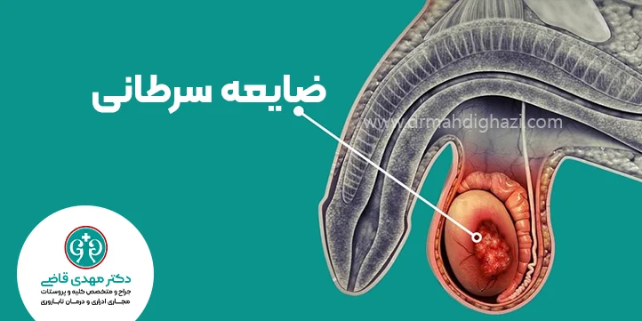 سرطان بیضه دکتر قاضی تشخیص بیماری
