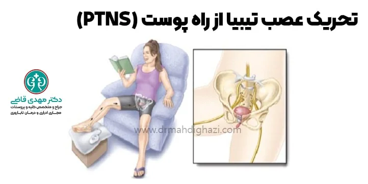 دکتر قاضی-درمان مثانه نوروژنیک-تحریک عصب تیبیا از راه پوست PTNS