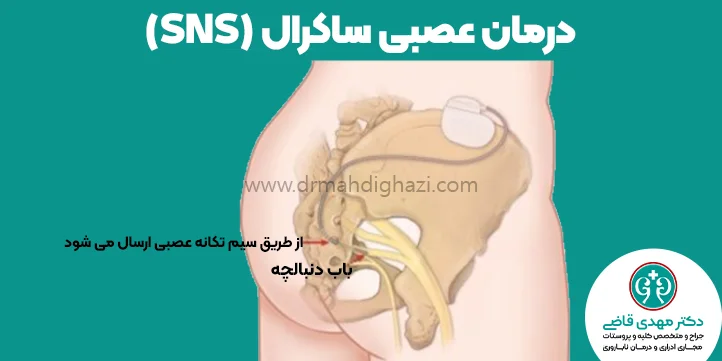 دکتر قاضی-درمان مثانه نوروؤنیک-درمان عصبی ساکرال SNS