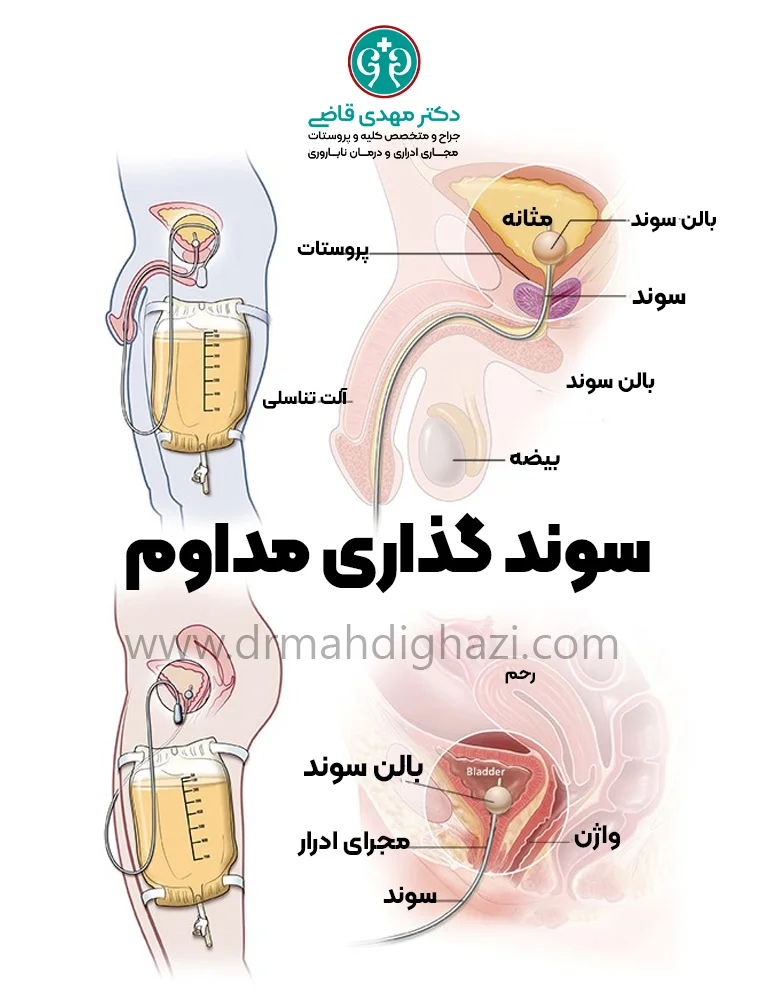 دکتر قاضی درمان مثانه نوروژنیک-سوندگذاری