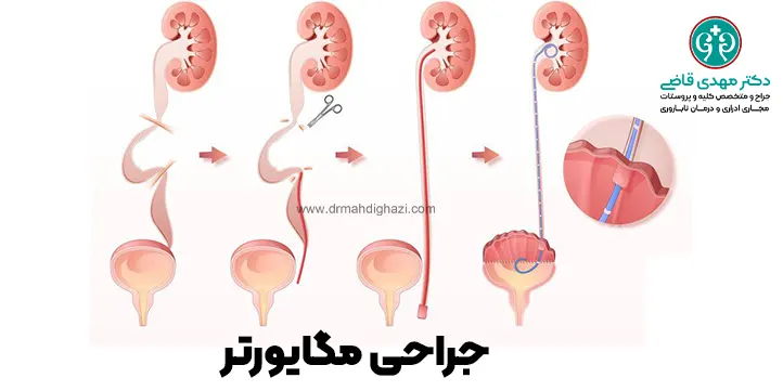 درمان مگایورتر بوسیله جراحی