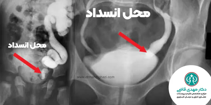 سونوگرافی برای تشخیص مگایورتر