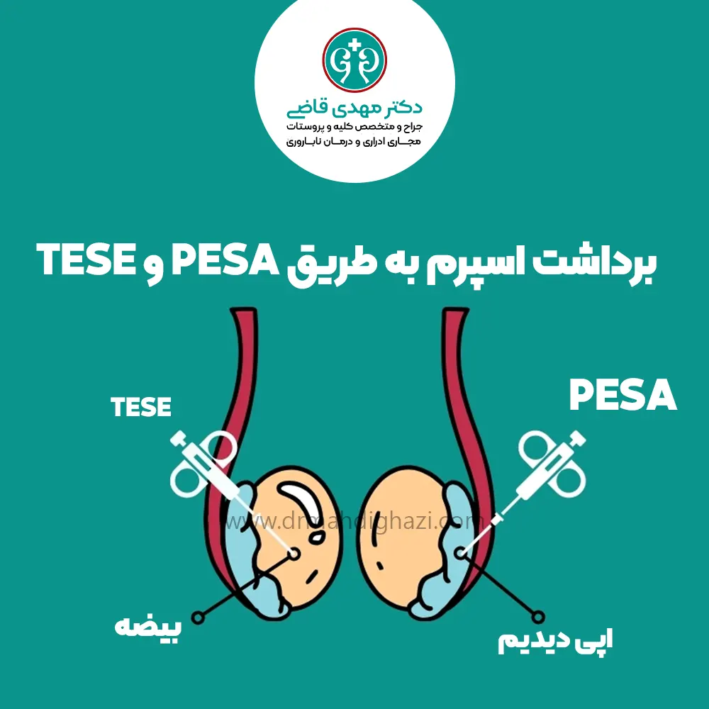 استخراج اسپرم