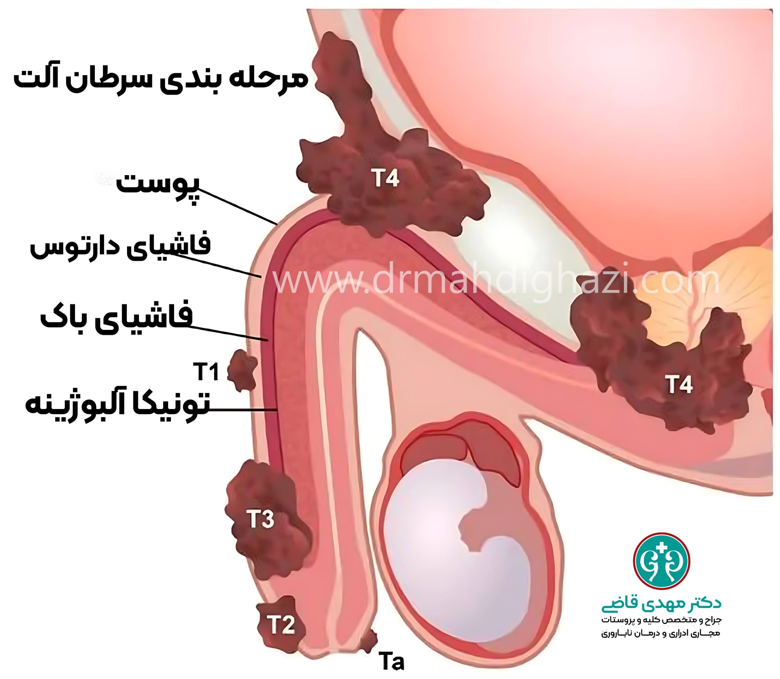 دکتر قاضی - مرحله بندی سرطان آلت تناسلی