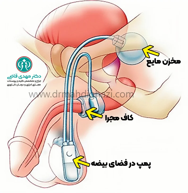 بی اختیاری ادرار استرسی مردان دکتر قاضی