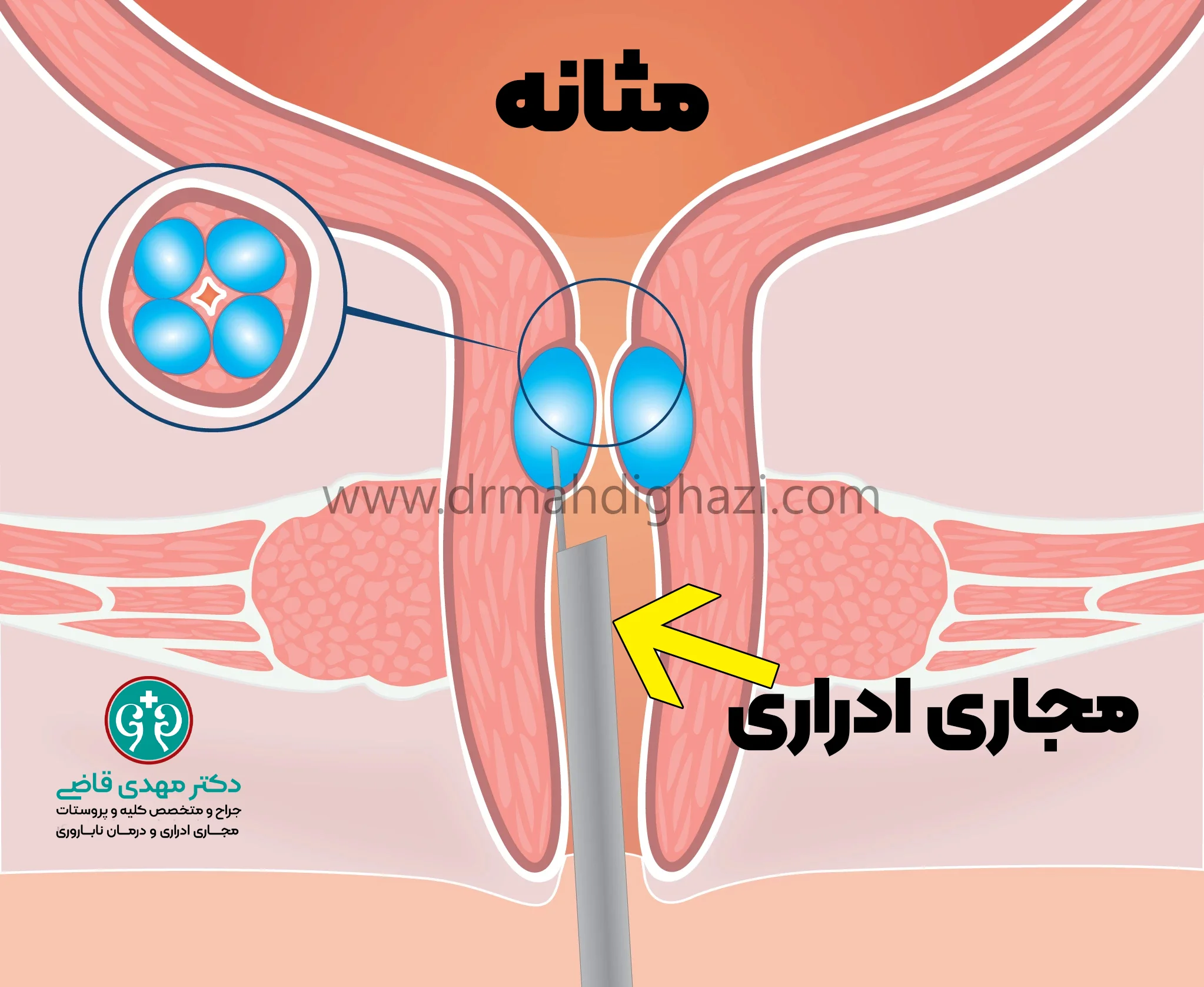دکتر قاضی بی اختیاری ادرار استرسی