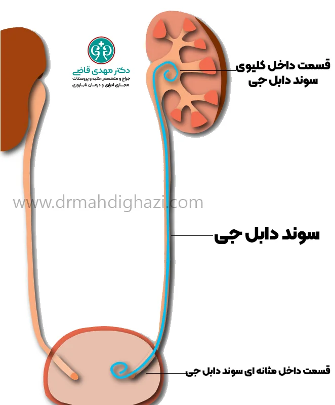 دکتز مهدس قاضی درمان انسداد حالب با سوند دابل جی