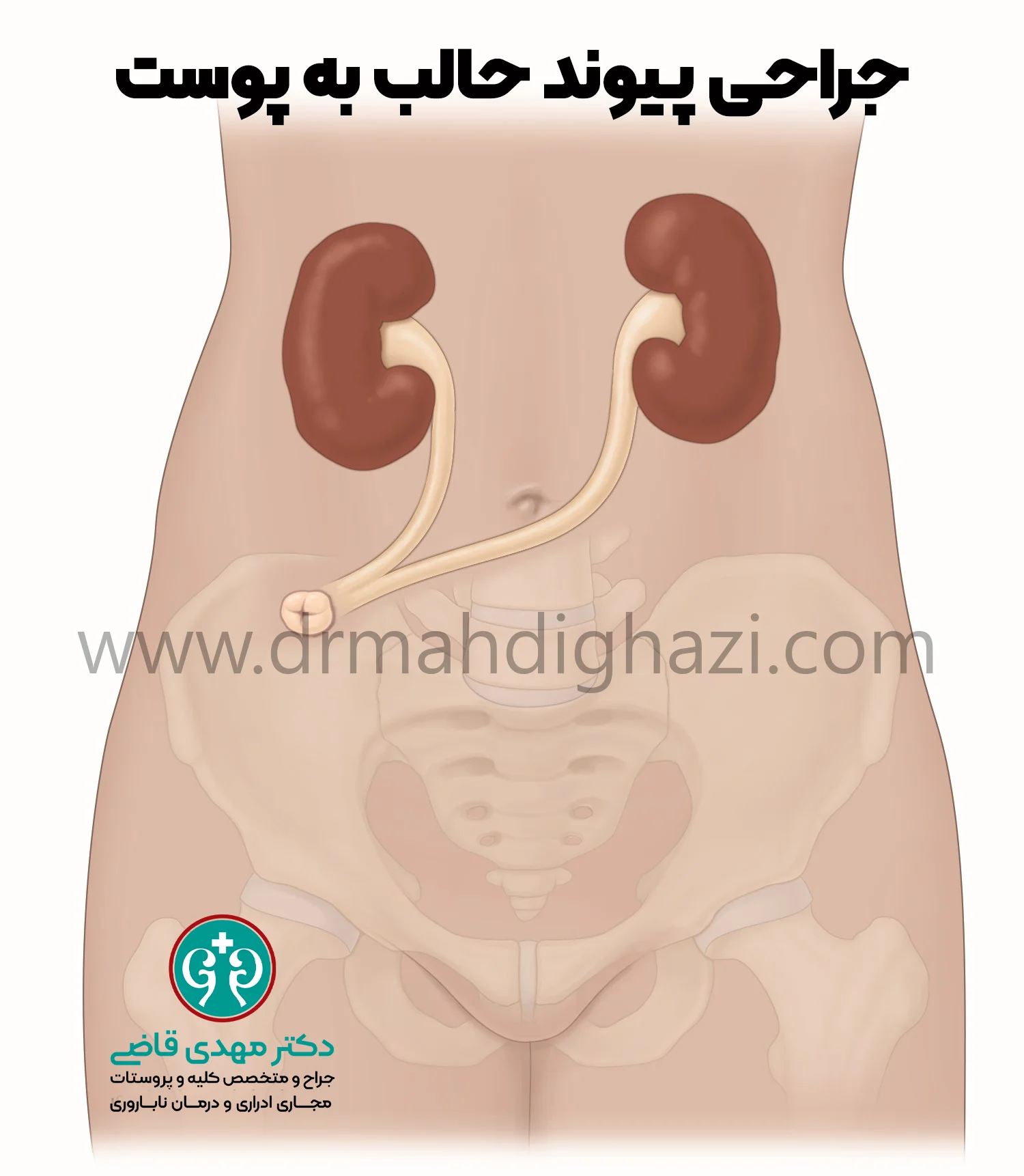 دکتر قاضی روش جراحی پیوند حالب یه حالب در انسداد حالب